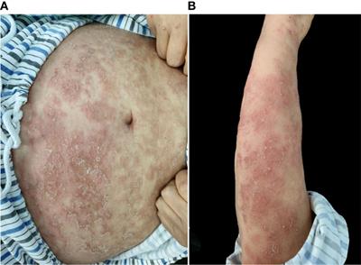 Case report: Successful treatment of acute generalized pustular psoriasis with multiple comorbidities with oral tacrolimus